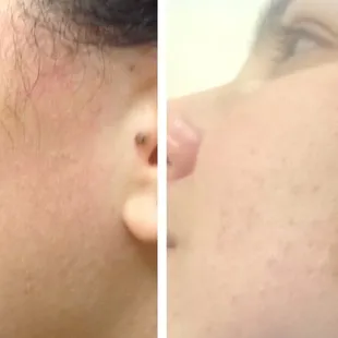 Hyper Pigmentation Treatment