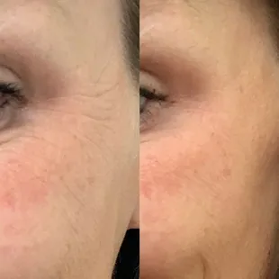 Botox before and after.