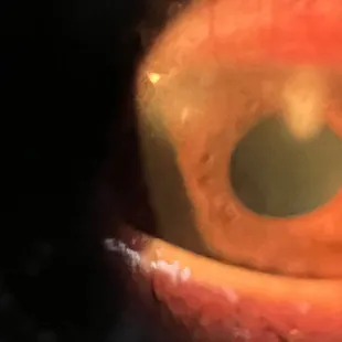 Corneal Bacterial Keratitis 
(eye infection)