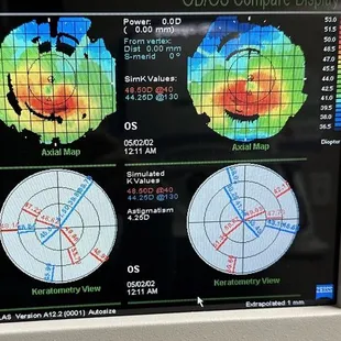 Corneal topography  Useful Keratoconus and ortho-K examine  Vision Care Optometry of Hanford