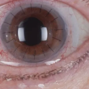 Scleral lens 
Specialty contacts
RK patient