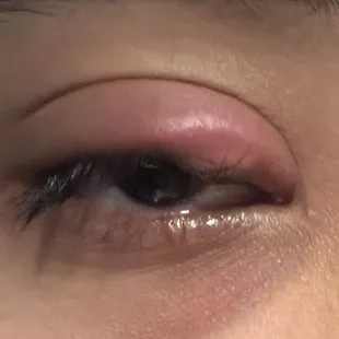 Hordeolum (stye)
Eyelid infection