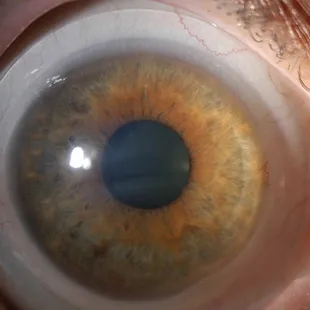 Scleral lens
Specialty contacts
Keratoconus patient