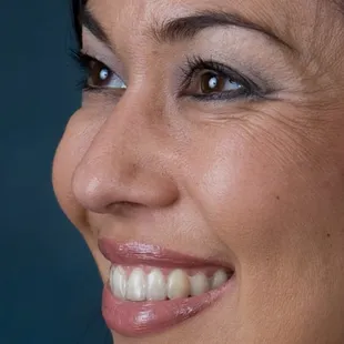 Before Botox treatment