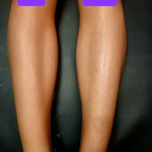 Legs wax Before and After