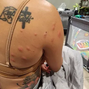 Bed bugs bites from the hotel, also on my fiancée arms and legs and mine too