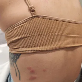 Bed bug bite
