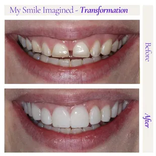 My Smile Imagined Transformation (Before &amp; After)