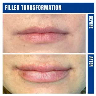 Filler Transformation Photos (Before &amp; After)