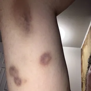 a photo of a man&apos;s arm with brown spots on it