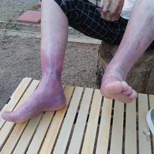 A resident of the mobile home park. Burned from standing in a tub of water to bathe. Her shower is inoperable.