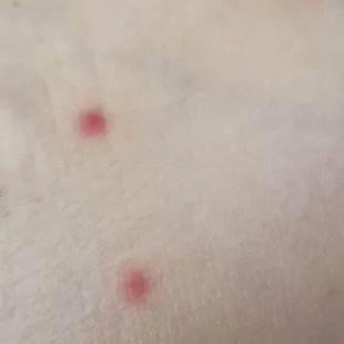 Flea bug bites
