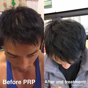 PRP Hair Restoration