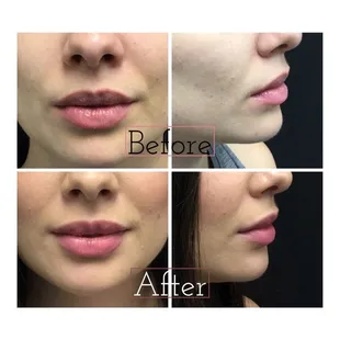 Subtle lip plump for smoothing- not all lip fillers need to add lots of volume