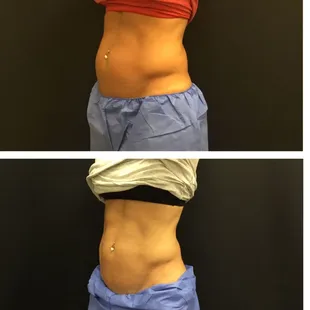Before and after CoolSculpting to the lower abdomen and flanks