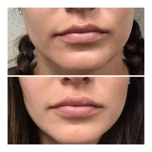 Before and after Restylane Defyne lip injection