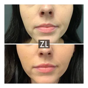 Lip Filler by Laura Zimmerman NP-C, CANS