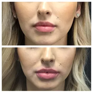 Lip augmentation with Juvederm