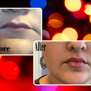Lip fillers Juvederm